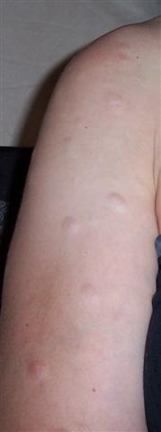 Anetoderma Face Anetoderma Support Group: Anetoderma Sufferers Support Group