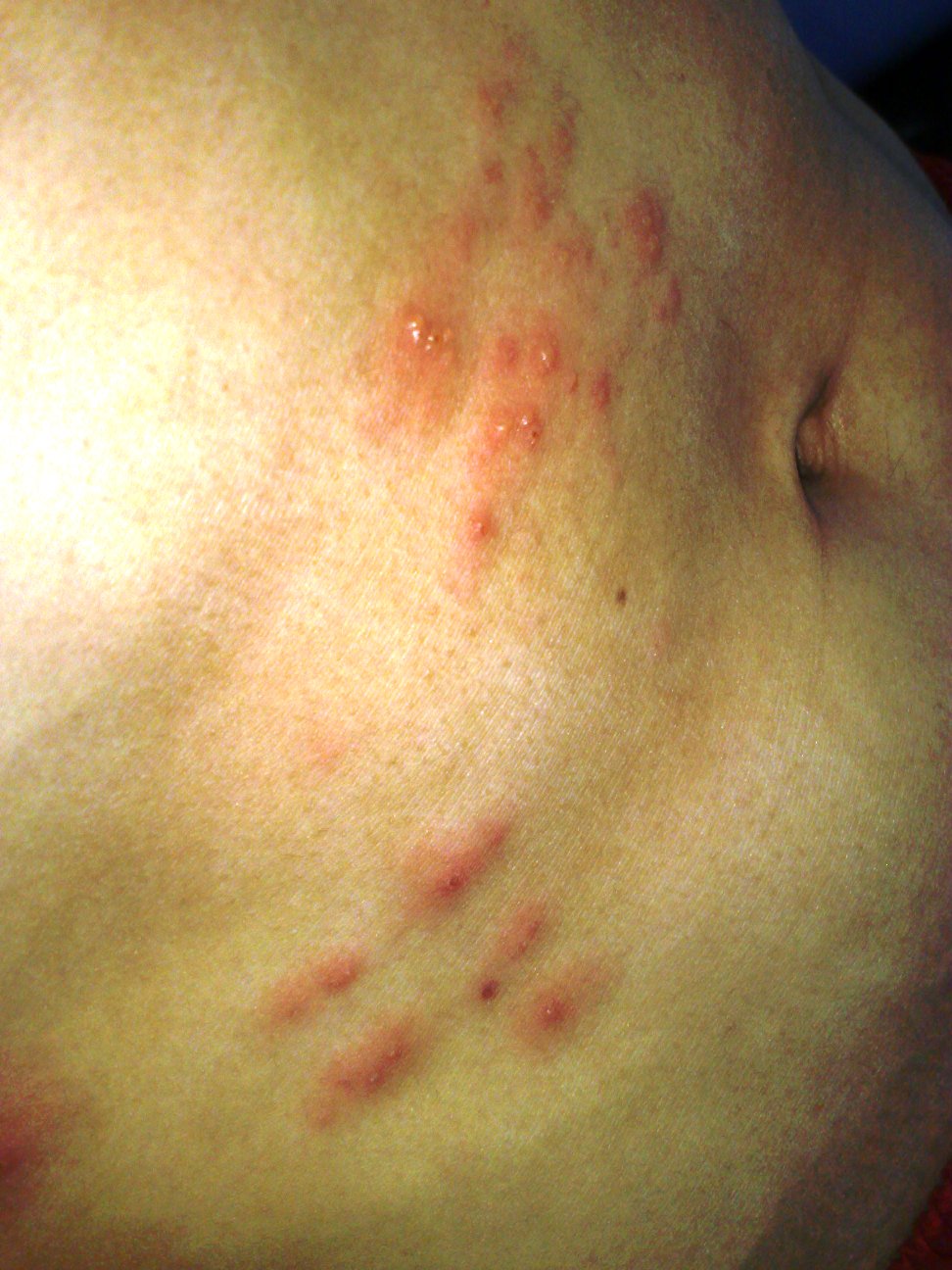 my TRIals in life I�ve got shingles!