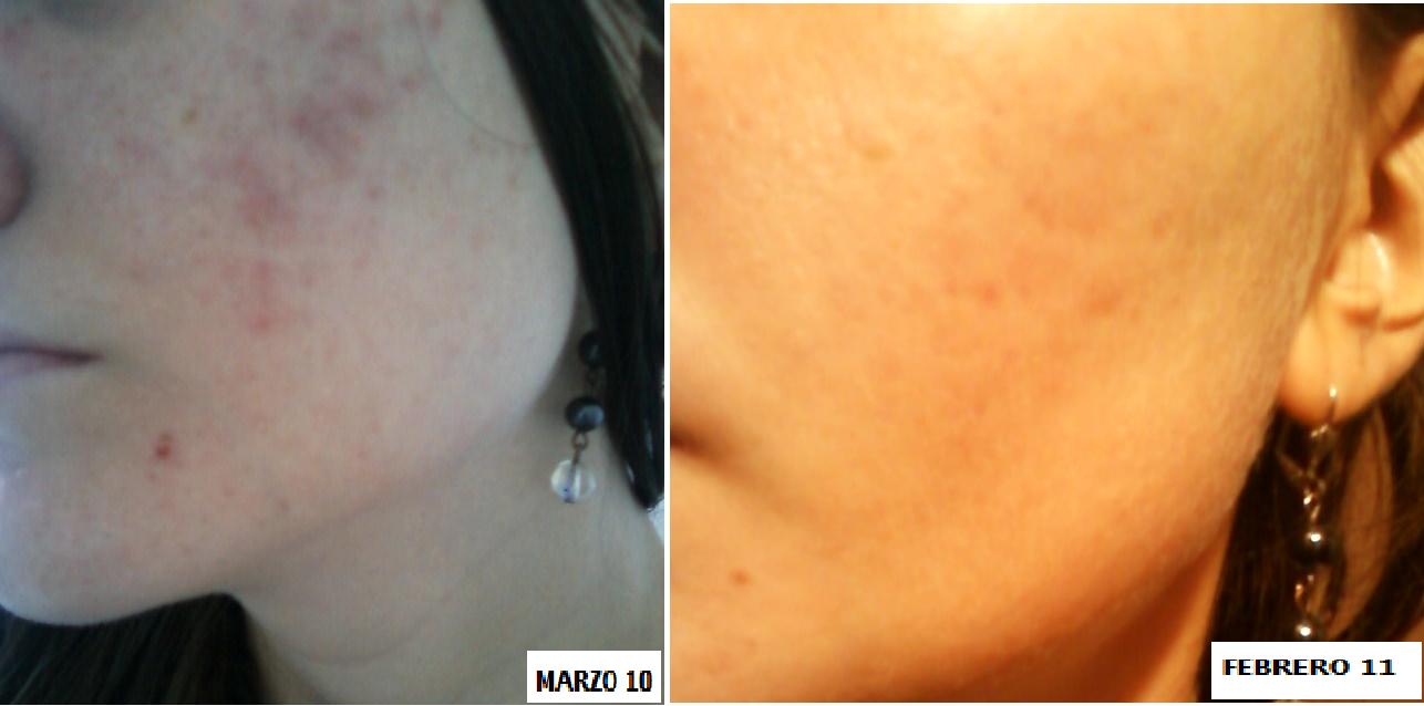 ACNE!a ver q pasa!ROACUTTAN,CURACNE(ISOTRETINOINA)