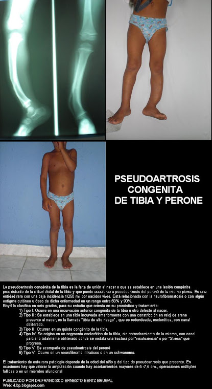PSEUDOARTROSIS CONGENITA DE TIBIA Y PERONE