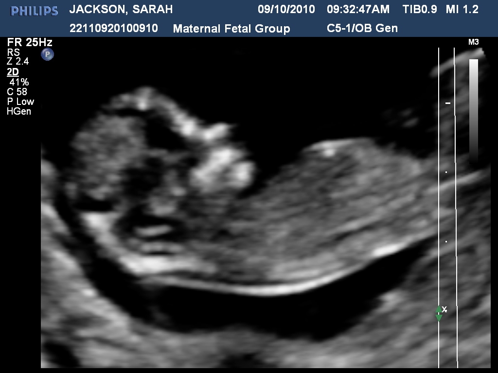 The Jackson Bump Baby J Pictures