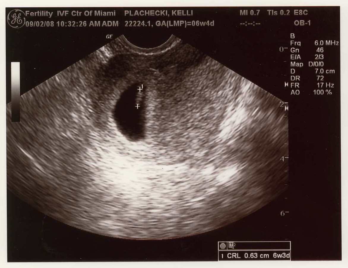 9 недель беременности размер плода. Эмбрион на 9 неделе беременности УЗИ. УЗИ плода на 9 акушерской неделе беременности. Эмбрион на 9 акушерской неделе беременности УЗИ.