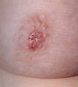 Paget's disease of the breast - ncbi.nlm.nih.gov