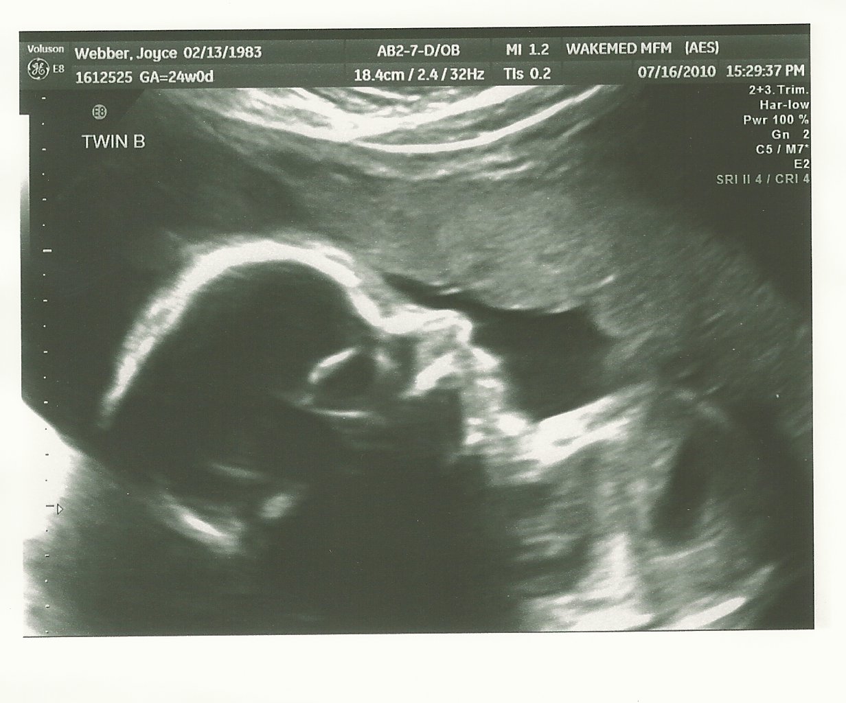 Two for One Special: 24 Week Ultrasound