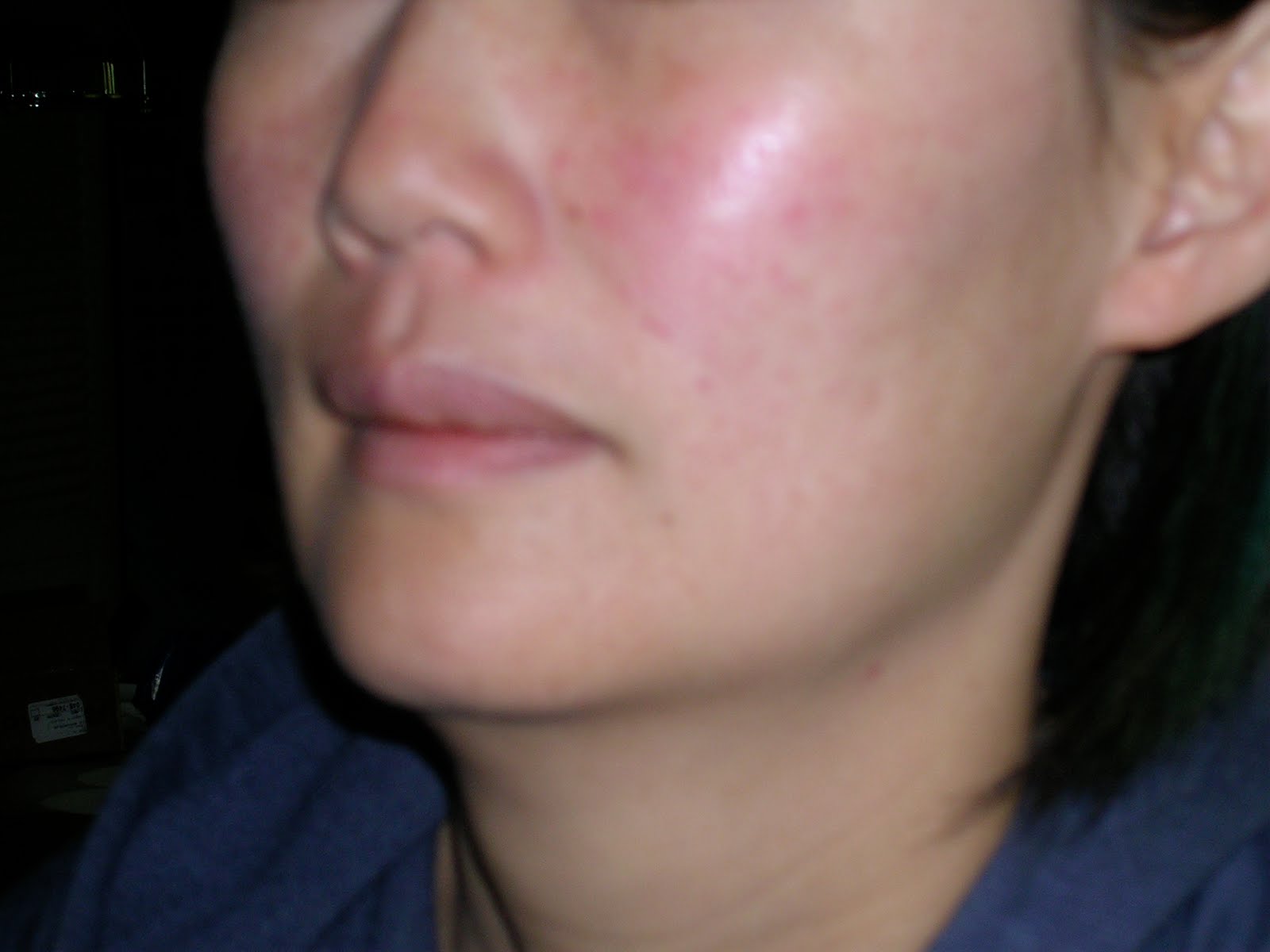 mild rosacea on face