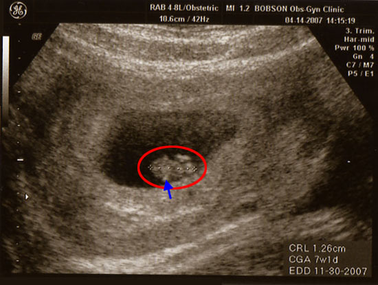 images of 5 week fetus. ultrasound scan at 5 weeks.