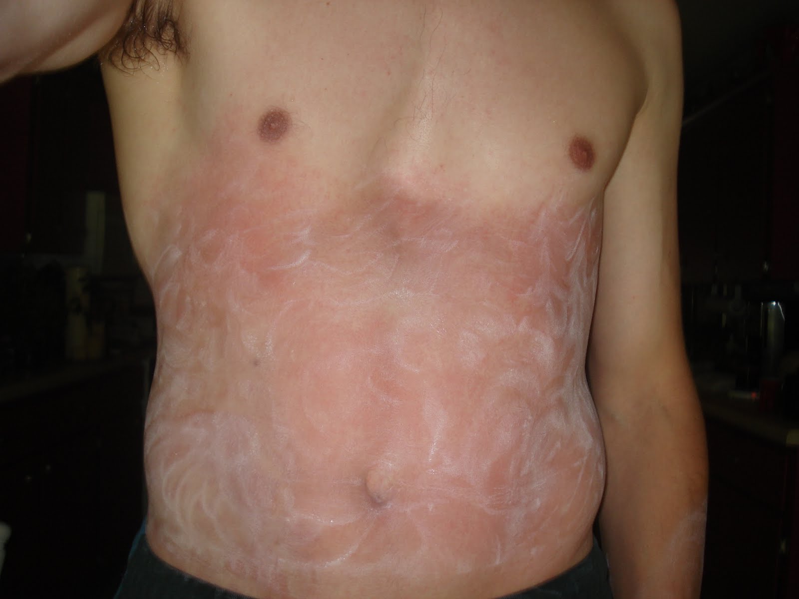 poison sumac rashes pictures