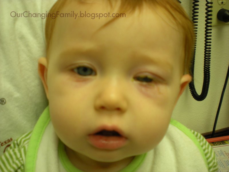 Our Changing Family Wordless Wednesday pink eye & strep throat