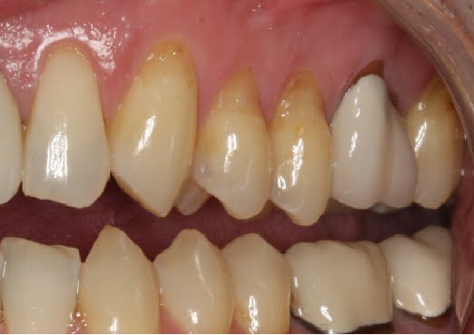 self love self care inspiration tooth abrasion