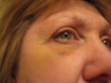 Black eye