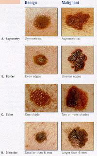 ABCDs of melanoma/skin cancer