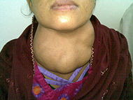 GUATIR(goiter )