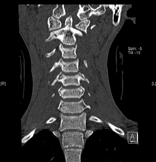 Neurosurgery Traumatic C2 dens fracture (Type II)