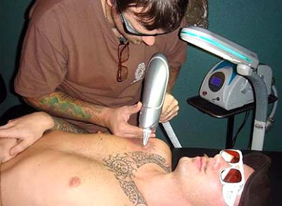 Laser Tattoo Removal - Free Yourself From That Tat