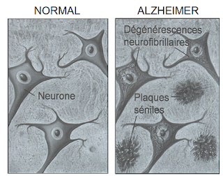La maladie d'Alzheimer: Définition, chiffres et symptômes