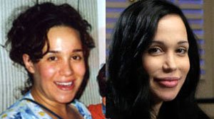 [nadya_suleman_before_after_surgery_2.jpg]