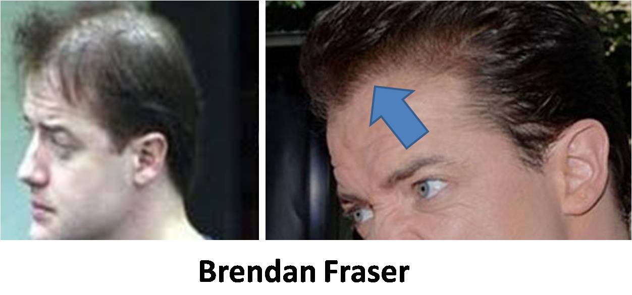 How about Brendon Fraser? raty tat tat said. ↑. norm. 