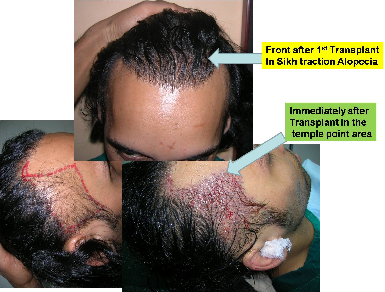 Good Bye Hair Loss Hair Loss Tips Advice Online Turban