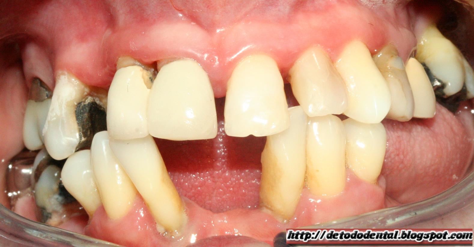 http://1.bp.blogspot.com/_RfhHjMj1Atg/TNwzh_GeiHI/AAAAAAAAATE/rFUkb6hvXCg/s1600/periodontitis.jpg