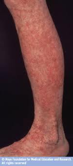 idiopatik trombositopenia purpura