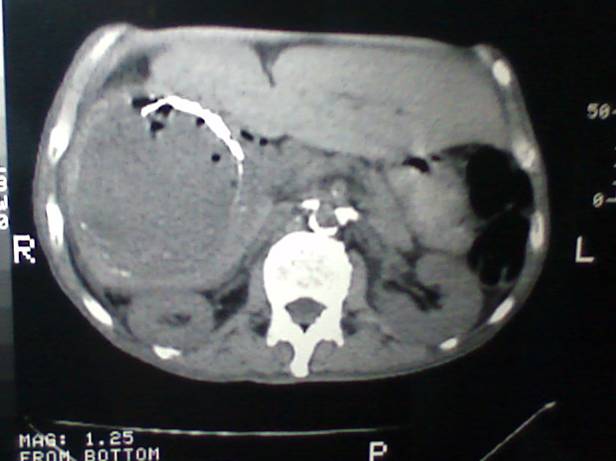 Quiste hepatico simple complicado