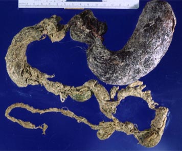 [Rapunzel+syndrome.jpg]