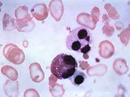 Cooleys Anemia Pictures 45