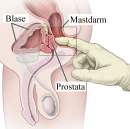 tratamentul prostatitei în sanos cmp prostate test