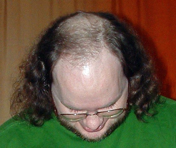 [Male_pattern_baldness.jpg]