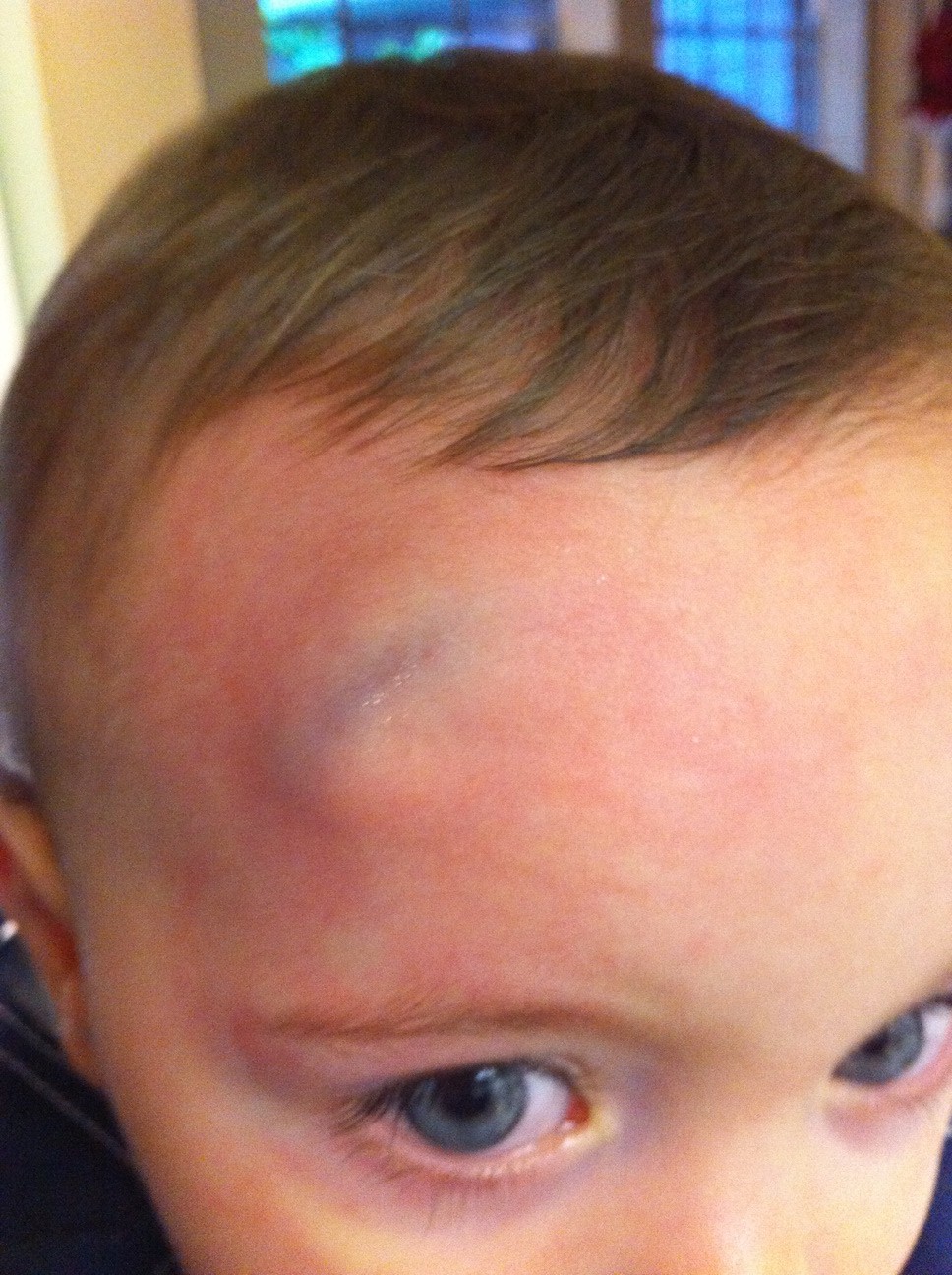 Bump On The Head Erin Franco bump-on-the-head-erin-franco
