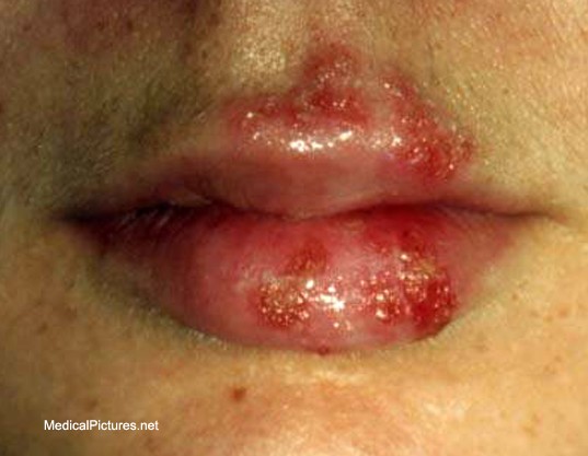 geographic tongue pain #9