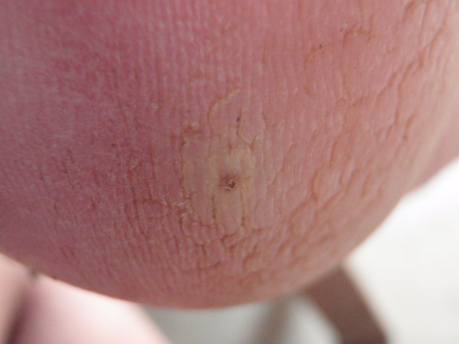 Holes In Skin On Feet