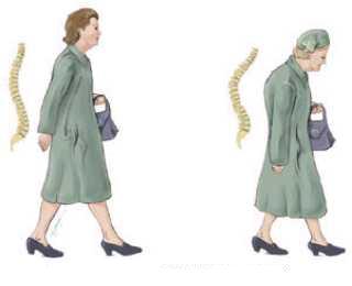 [KEMİK+ERİMESİ.jpg]