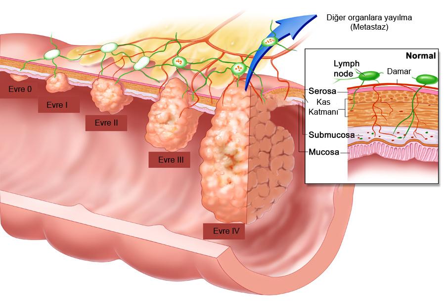 [BARSAK+KANSERİ+NEDİR+NASIL+BESLENMEK+GEREKİR.jpg]