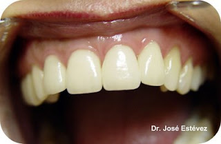 prótesis dentales clínica dental dr. Estévez