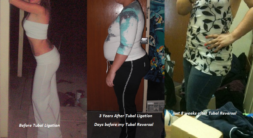 Post Tubal Ligation Syndrome 2010