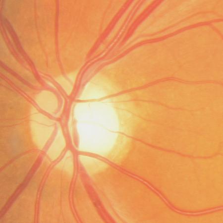 [13+Atrofia+óptica.JPG]