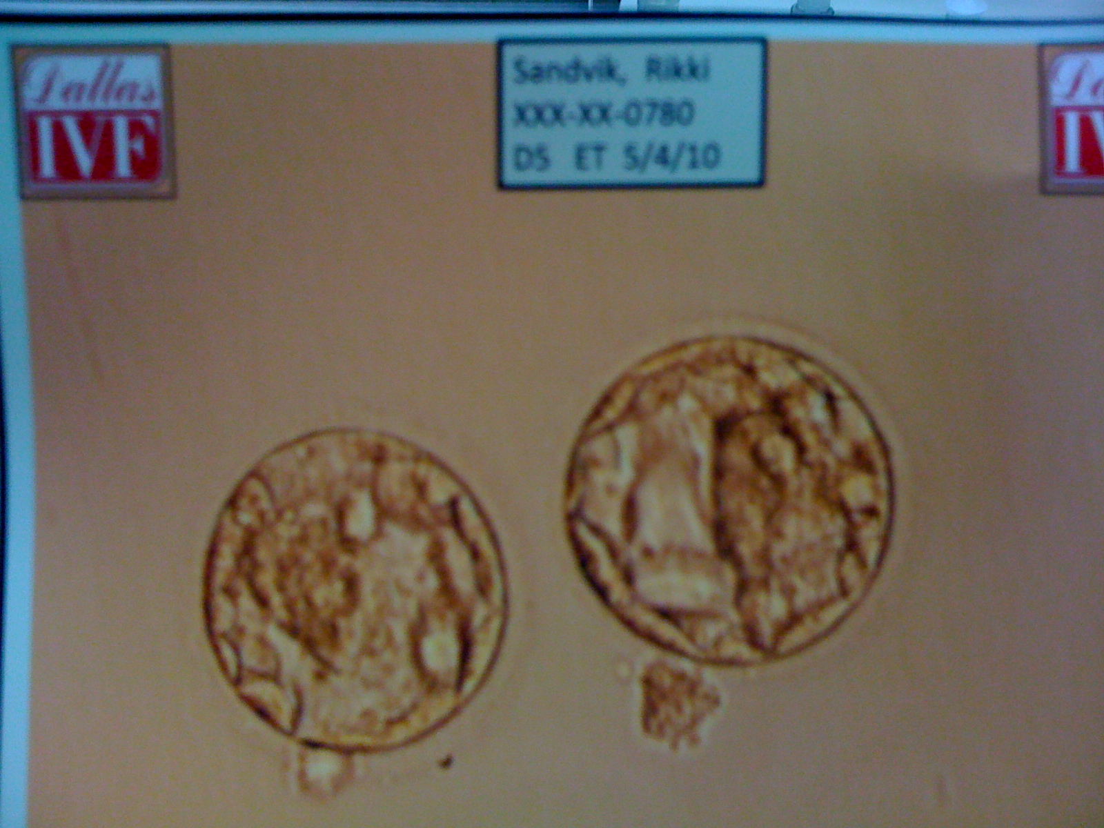 hoping4twins-5-day-embryo-transfer