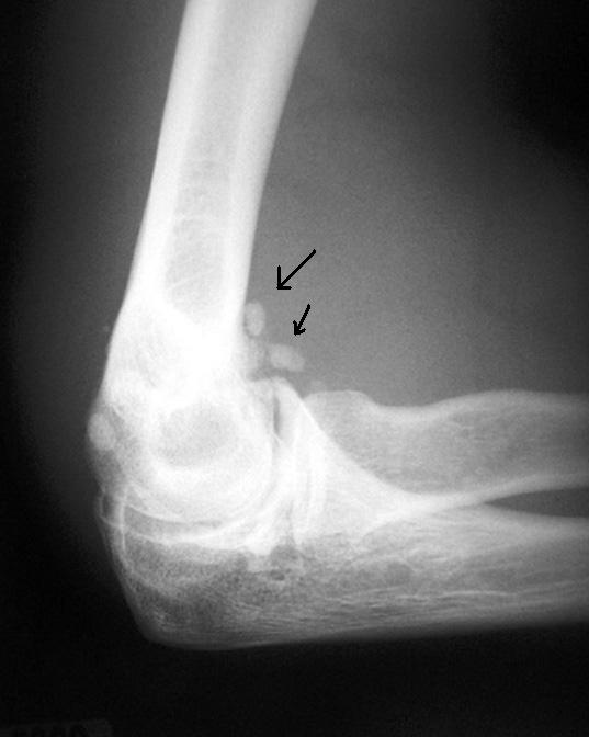 From the Mind of a (Newly Graduated) Chiropractic Student Radiology 5 Synovial Chondromatosis