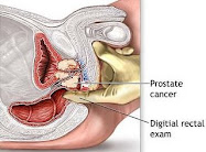 Prostate Cancer