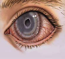 [20090324_mgb_Queratitis_.jpg]