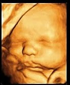 Baby Sophia at 35 wks
