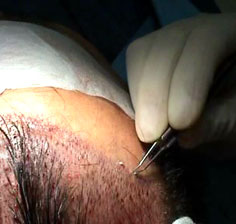 [leb-i+derya+saç+ekimi.jpg]