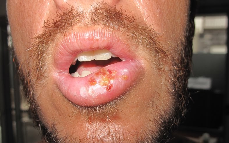 lip infection pictures