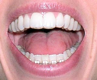 invisalign teeth procedure review before front need profile crooked