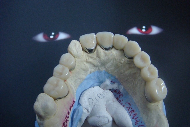 PUENTE FIJOS ~ Laboratorio de Prótesis Dental Santos