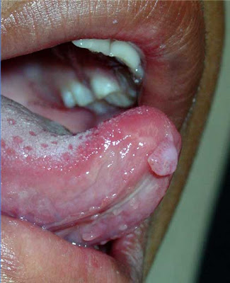 Oral Cancer Pictures