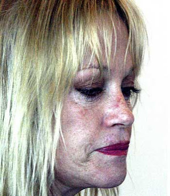 Melanie Griffith Awful plastic surgery