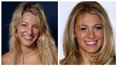 Plastic Surgery Before And After: Blake Lively Plastic Surgery