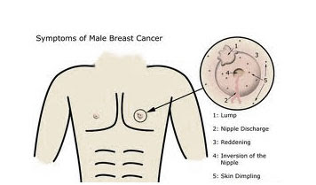 Male Breast Cancer Symptoms